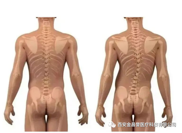 青少年脊柱側(cè)彎科普月，金昌譽(yù)與您一同守護(hù)青少年脊柱健康